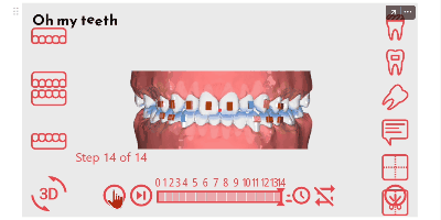 zk243 すきっ歯症例シミュレーション