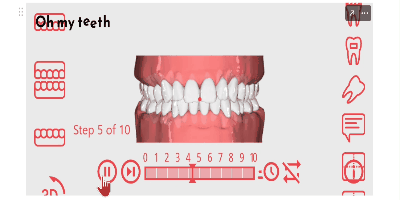 vd425　すきっ歯症例シミュレーション