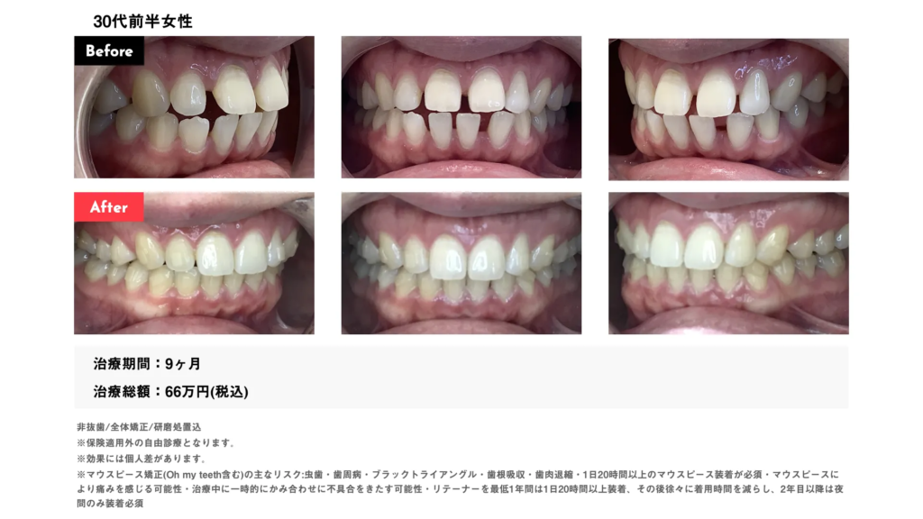 cl513　すきっ歯全体矯正の症例