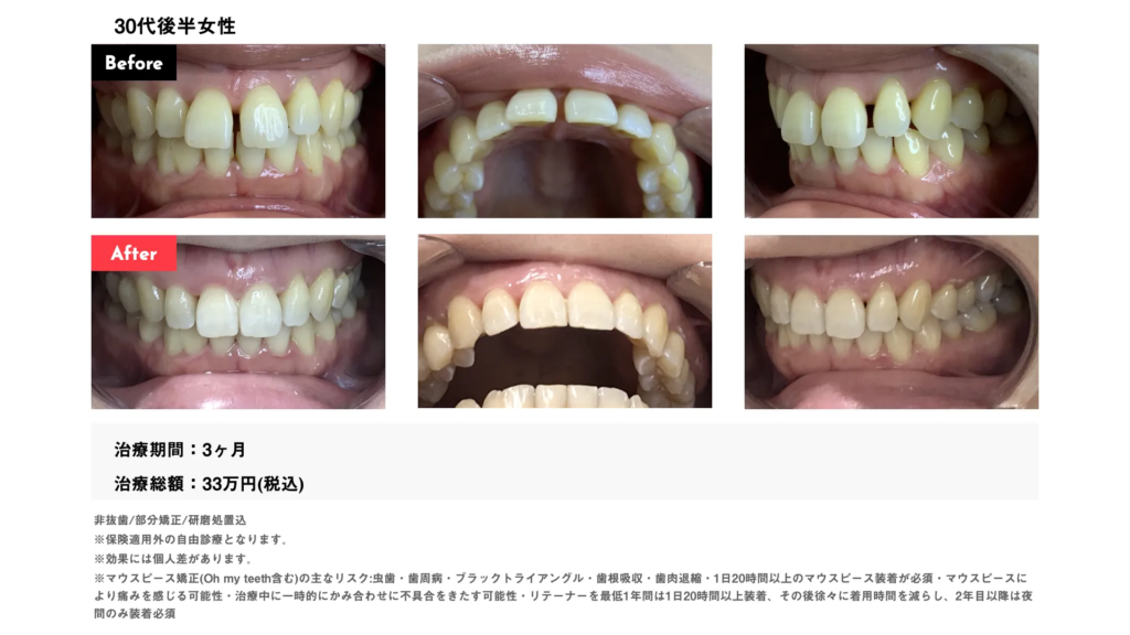 vd425　すきっ歯症例