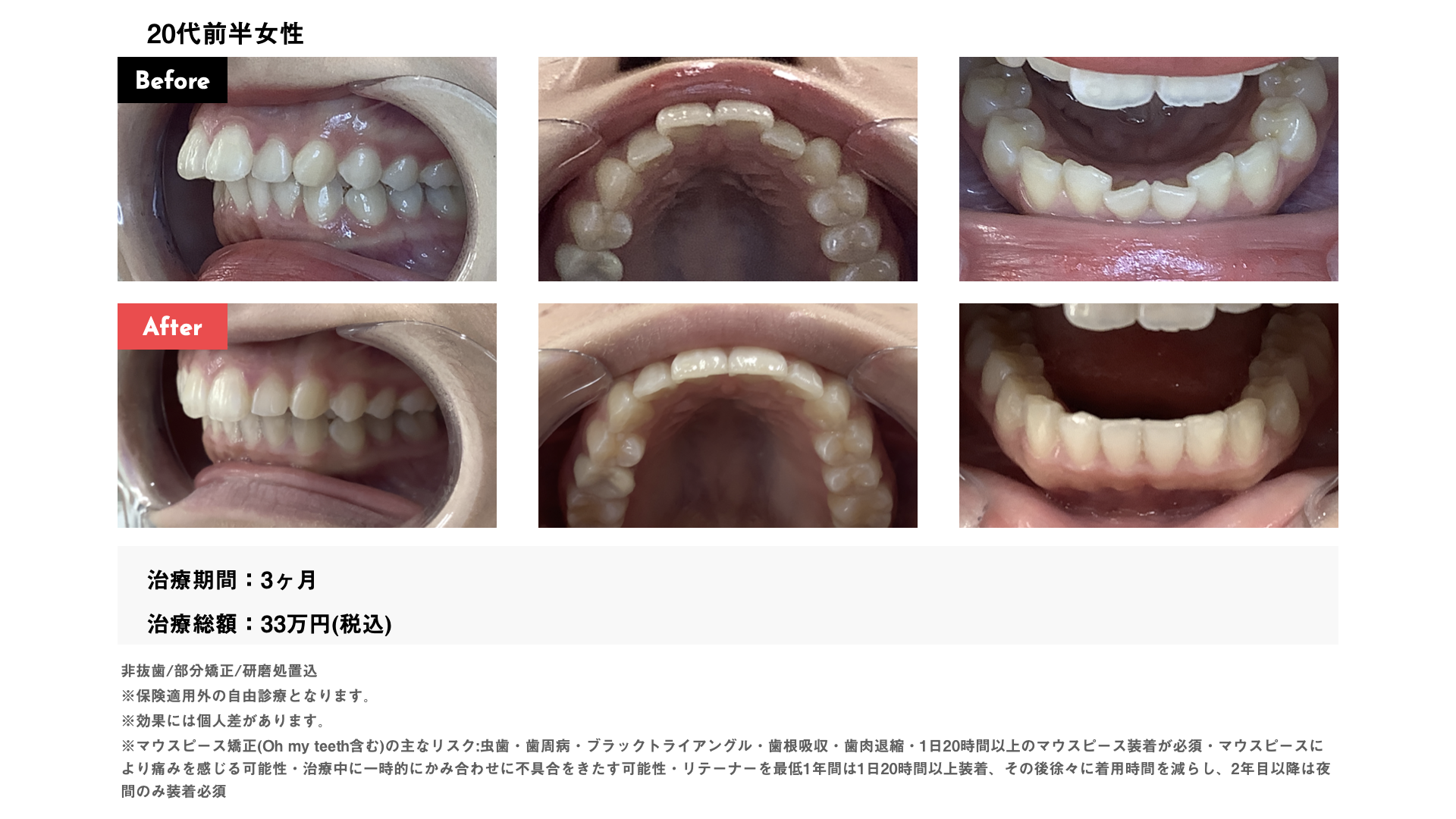 【写真あり】出っ歯矯正のビフォーアフター7 選!横顔の印象・費用・期間もまるごと紹介 | 名古屋 歯列矯正ナビ